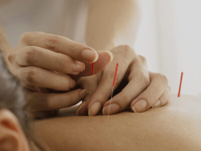 1693663019 acupunture 5